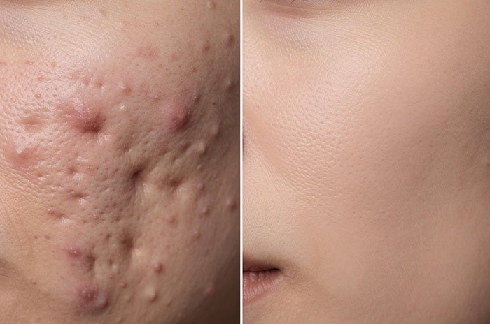 Acne Scar Removal & PRP Treatment