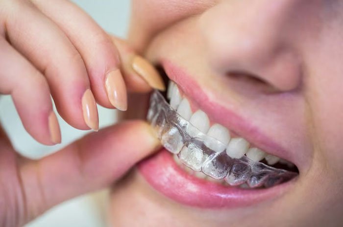 Aligners and Invisalign Treatment