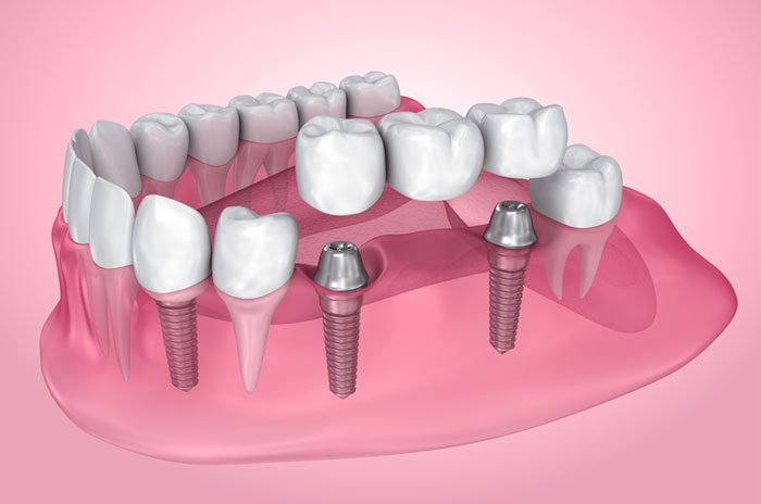 Dental Implants Treatment