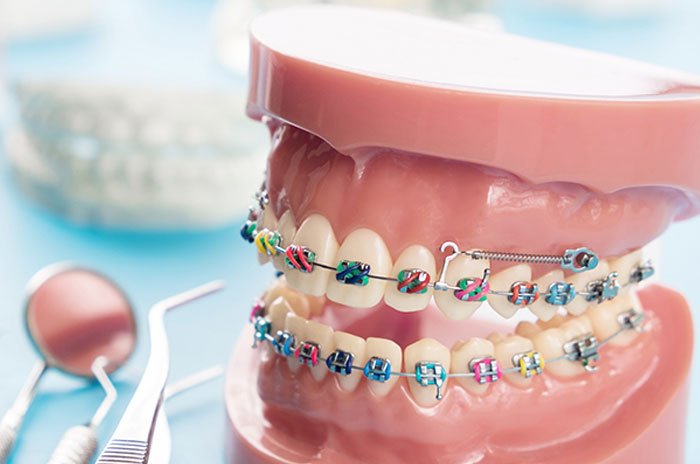 Orthodontic Treatment