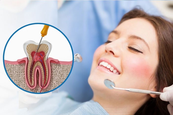 Single Sitting Root Canal Treatment